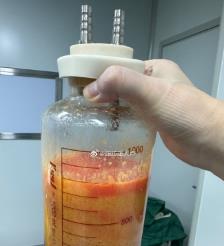 襄垣水动力吸脂手术要做多久？